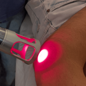 laser acupuncture